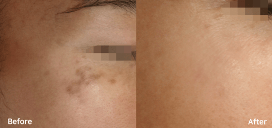 Bluecore Company - IRIS - Before & After Facial Rejuvenation