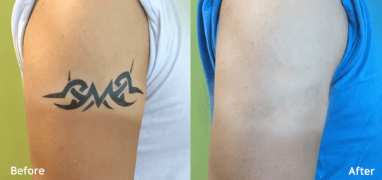 Bluecore Company - IRIS - Before & After Tattoo Removal