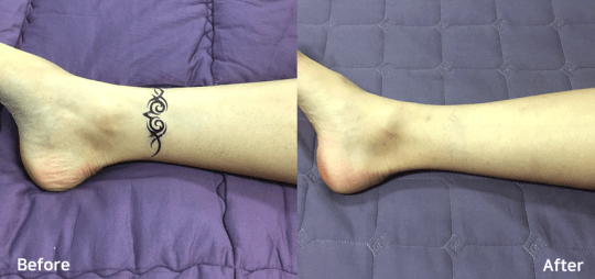 Bluecore Company - IRIS - Before & After Tattoo Removal