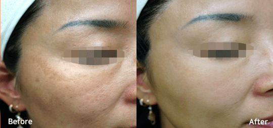 Bluecore Company - IRIS - Before & After Facial