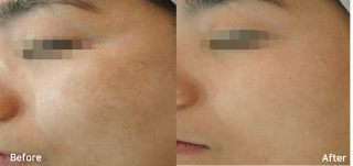 Bluecore Company - IRIS - Before & After Facial Rejuvenation