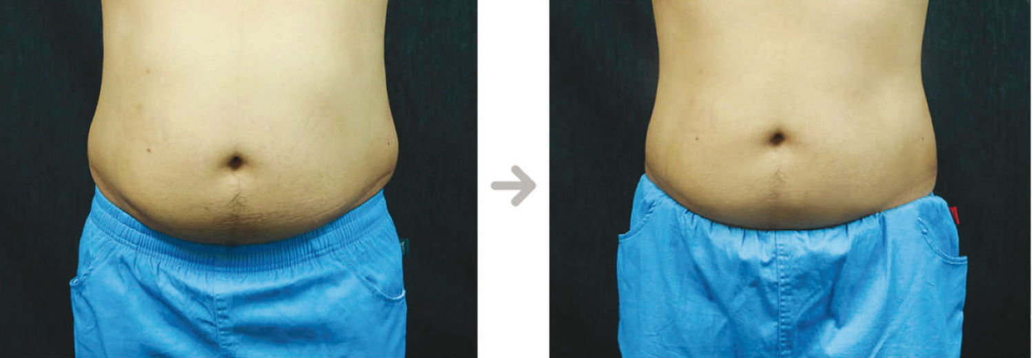 Slimus - Clinical Before & After Photos Abdomen