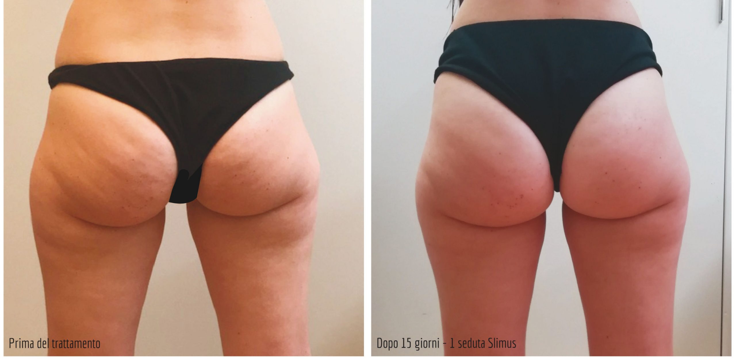 Slimus - Clinical Before & After Photos Glutes