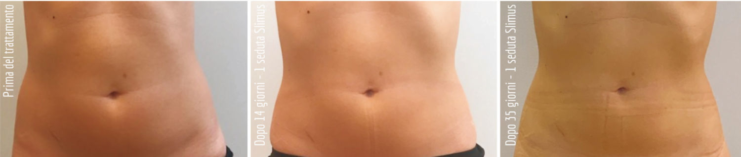 Slimus - Clinical Before & After Photos Abdomen