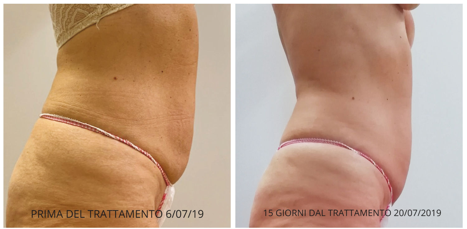 Slimus - Clinical Before & After Photos Abdomen